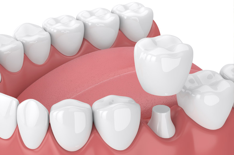 Dental Crowns in Tampa