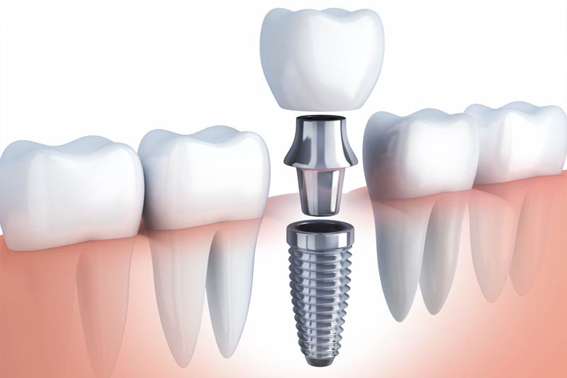 Dental Treatments in Tampa