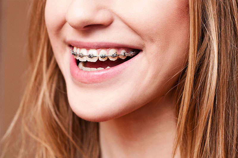 Orthodontics in Tampa