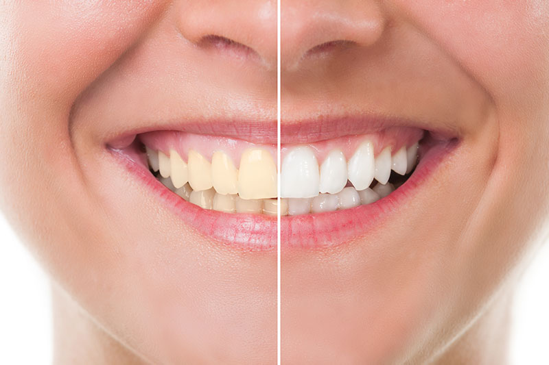 Teeth Whitening in Tampa