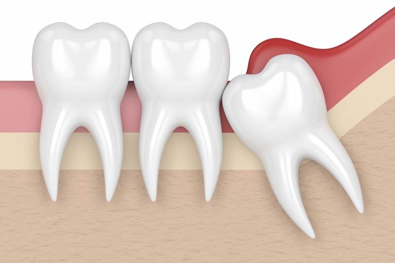 Wisdom Tooth Removal in Tampa